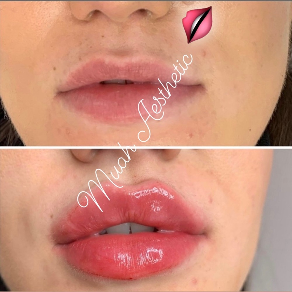 Hyaluronic acid - Picture 2 of 2